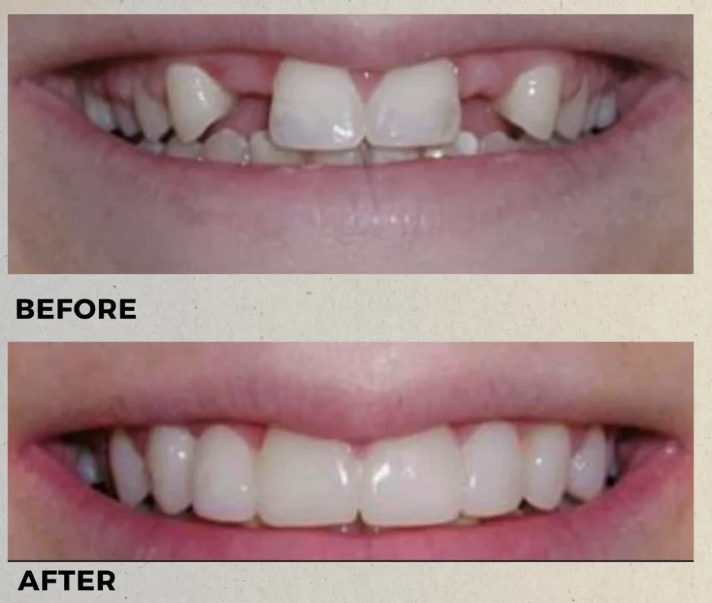 Zirconia Crowns: Teeth Before and After Results