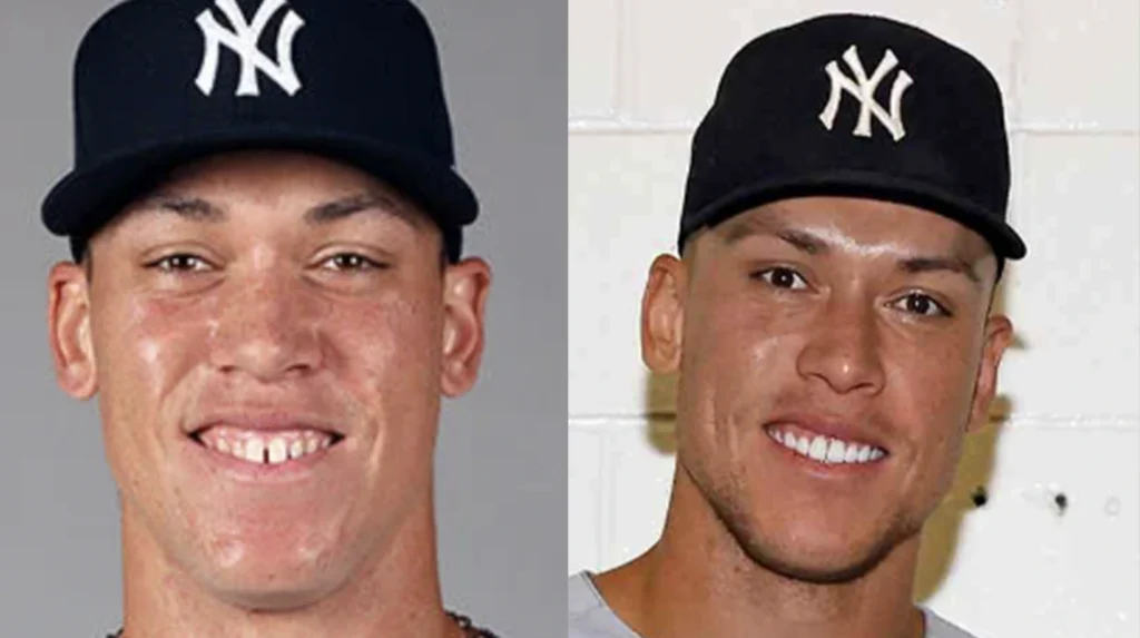 Aaron Judge’s Teeth Before and After