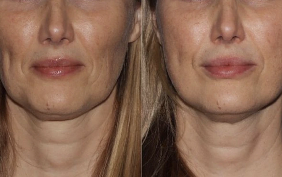 DAO Botox Before and After