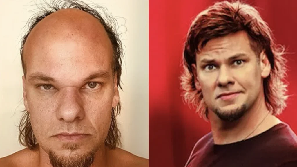 Theo Von Hair Transplant Journey